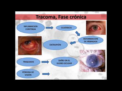 Vídeo: Perfil Transcriptómico Conjuntival De Los Isleños De Solomon Con Tracoma Activo En Ausencia De Infección Por Chlamydia Trachomatis