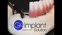 Jarrett | Golpa G4 Implant Solution | Patient Testimonial 