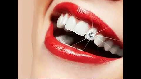 Đính đá, kim cương vào răng |Nha khoa Sài Gòn Dental