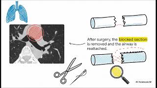 Lung Cancer Staging: Beyond TNM & Surgical Resectability Guide