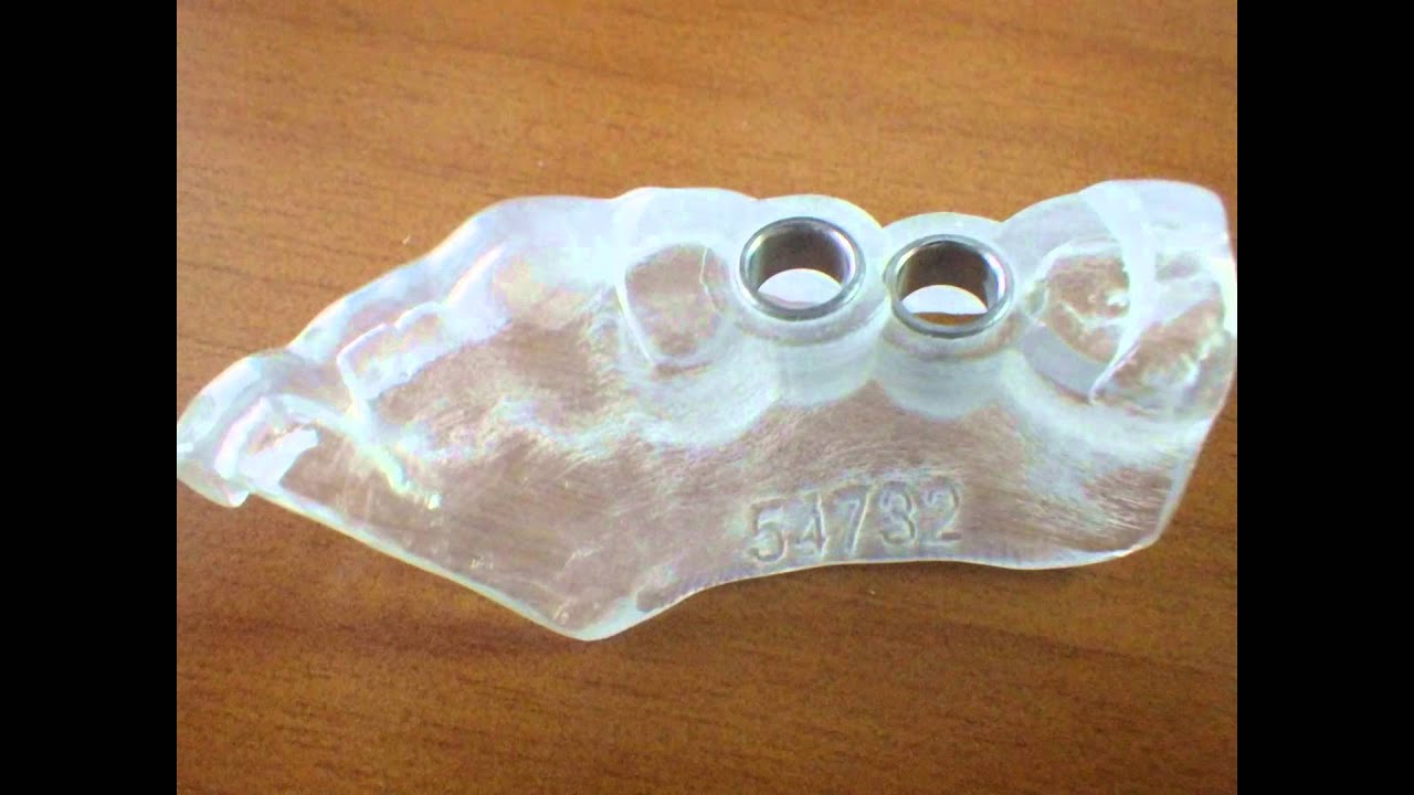 Perfect parallel dental implants with computer surgical guide YouTube