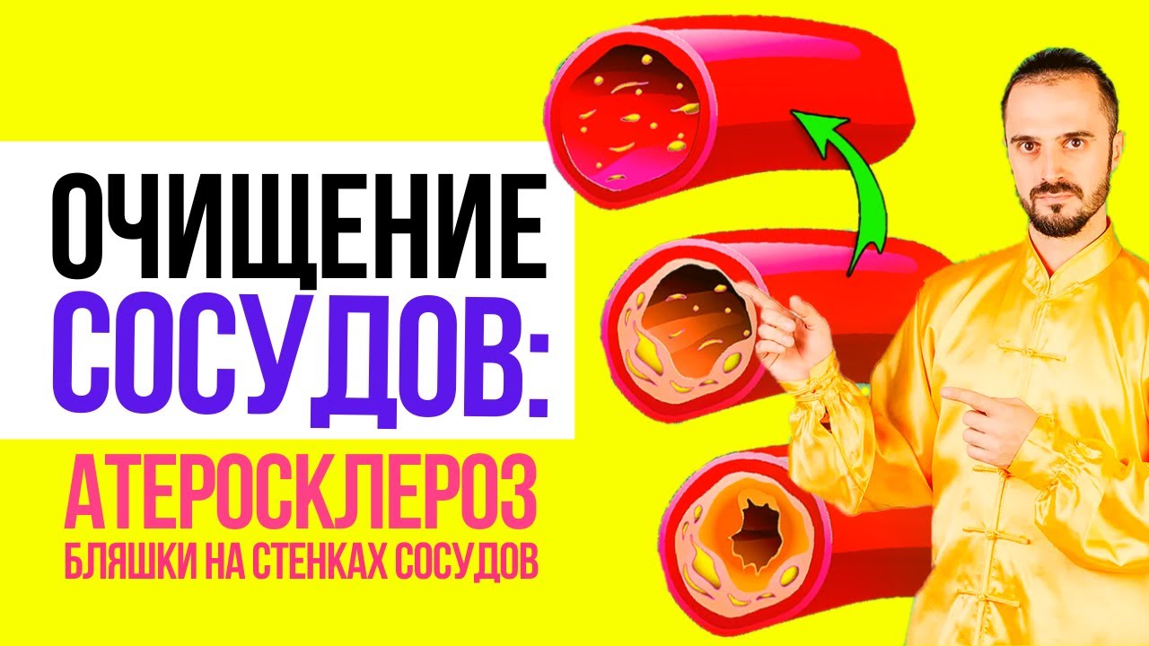 Атеросклероз, бляшки на стенках сосудов: профилактика и лечение ...