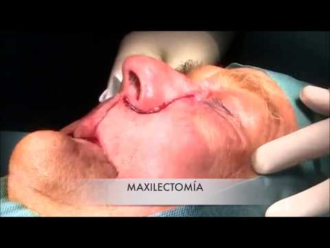 Video: Pua Na Saratani Ya Sinus (Squamous Cell Carcinoma) Katika Mbwa