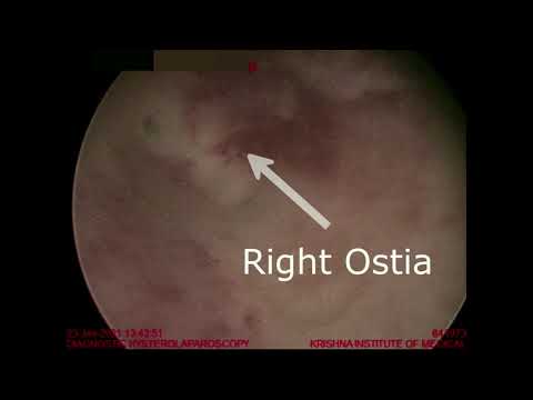 Video: De Gerandomiseerde Uteriene Septum-transsectieproef (TRUST): Ontwerp En Protocol