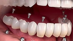 The Cost Of Dental Implants Might Surprise You 2018 