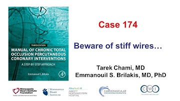 Case 174: Manual of CTO PCI - Beware of stiff guidewires...