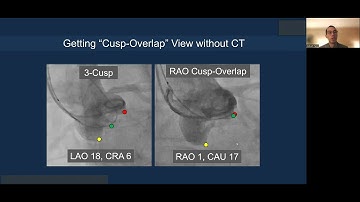 Lecture: Cusp Overlap and Commissural Alignment in TAVR