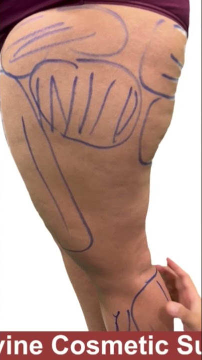 Thigh Liposuction along with Buttock Reshaping