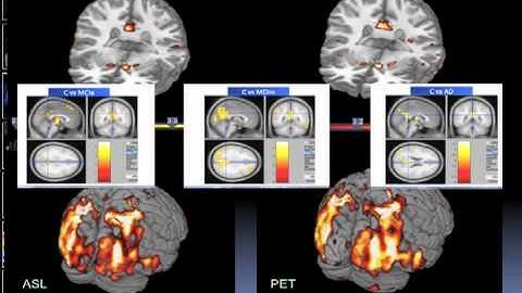 Arterial Spin Labeling in Elderly People and Neurodegenerative Diseases - Norberto Malpica