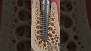 #dental #implant
