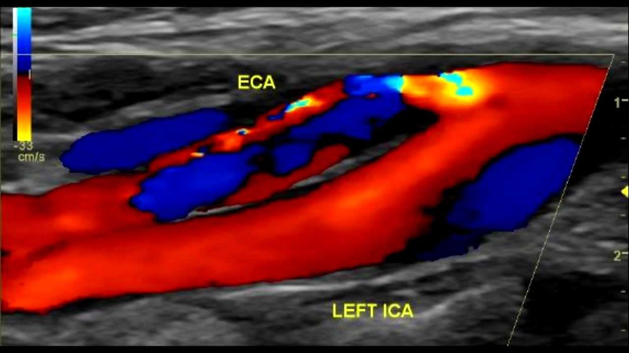Carotid artery dissection - YouTube
