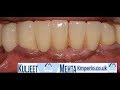 Dental implant lower bridges.