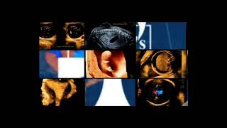 Fetal Umbilical Cord Cyst | Dr Sudhanshu Tandon