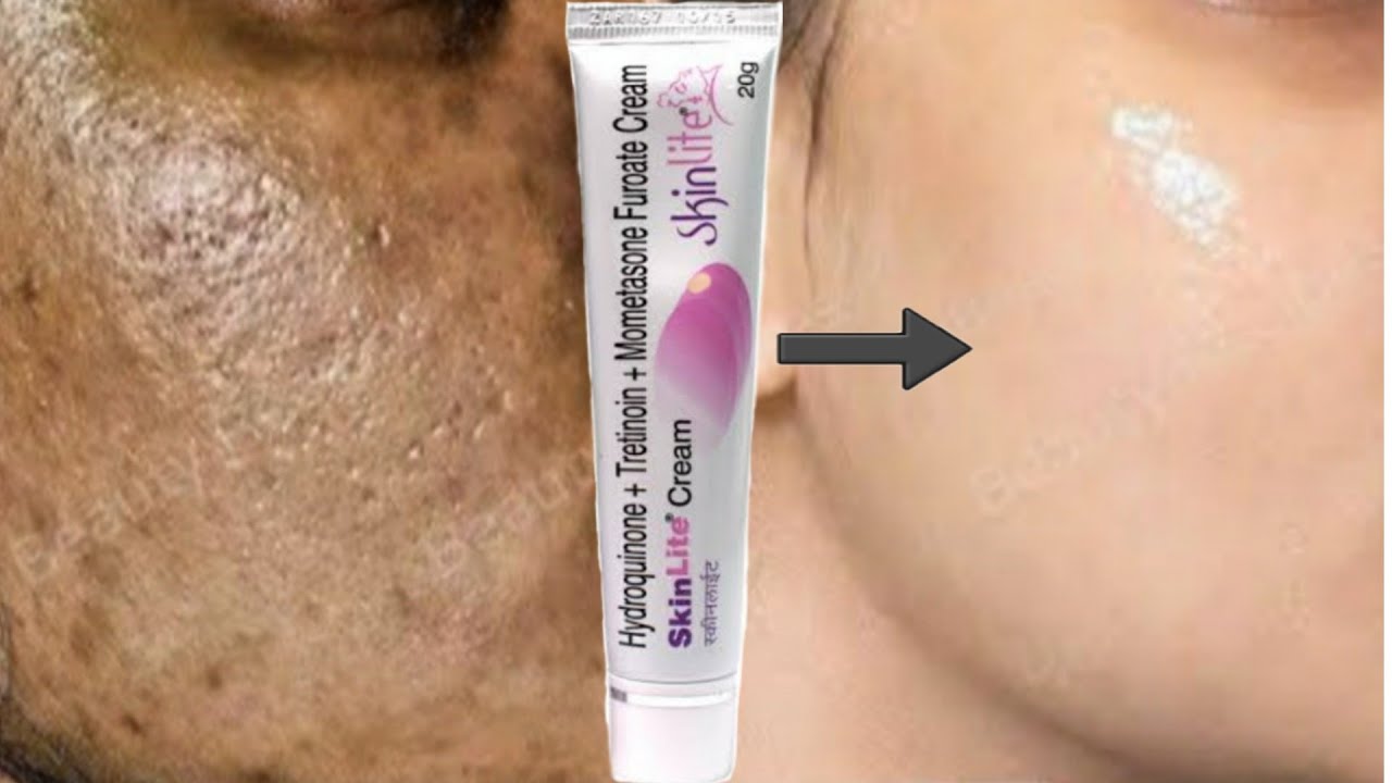 mometasone furoate cream for dark spots