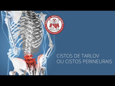 Cistos de Tarlov ou Cistos Perineurais - Dr Diogo Neurocirurgião