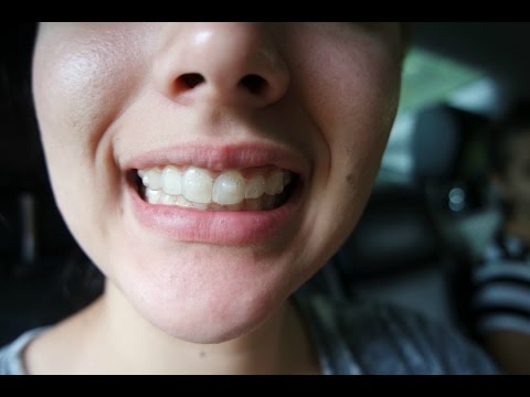 Invisalign Tray one!!!