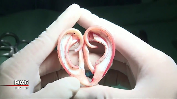 Ear grown on man's arm