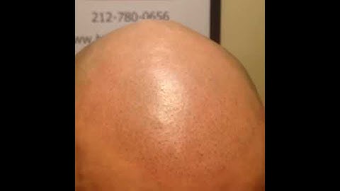 3d Scalp Micropigmentation nyc with Chris Mr. Natural & Discreet