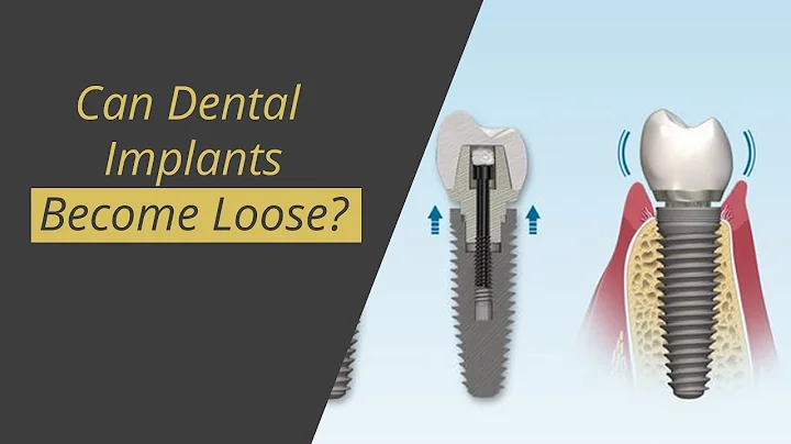 Preventing Loose Dental Implants: Expert Tips and Solutions