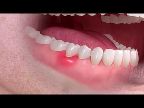 Gum disease (periodontitis)