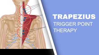 Trapezius Trigger Points and Headaches