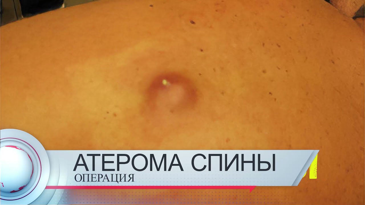 Атерома спины. Проведение операции при нагноении атеромы. - YouTube