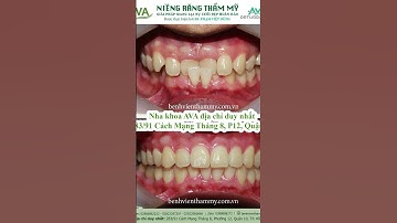 Niềng răng trước và sau tại Nha khoa AVA - Niềng răng móm #niengrang #niềngrăngtrongsuốt