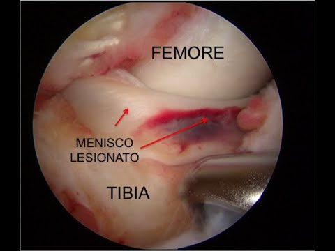 Lesioni del menisco a manico di secchio