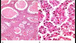 Clear Cell Tumor Ovarian Cancers ; Definition, Pathology, Characteristics, Diagnosis, Treatment