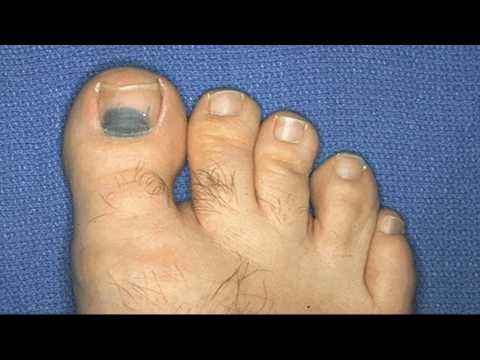 Video: Cum să previi căderea unghiilor de la picioare?