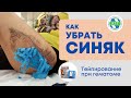 Как быстро убрать синяк? Тейпирование при гематоме. Аппликация фонарик