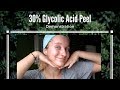 ♡ At Home 30% Glycolic Acid Peel Tutorial ♡ Fade Acne Scars ♡ How to Fade Acne Scars ♡