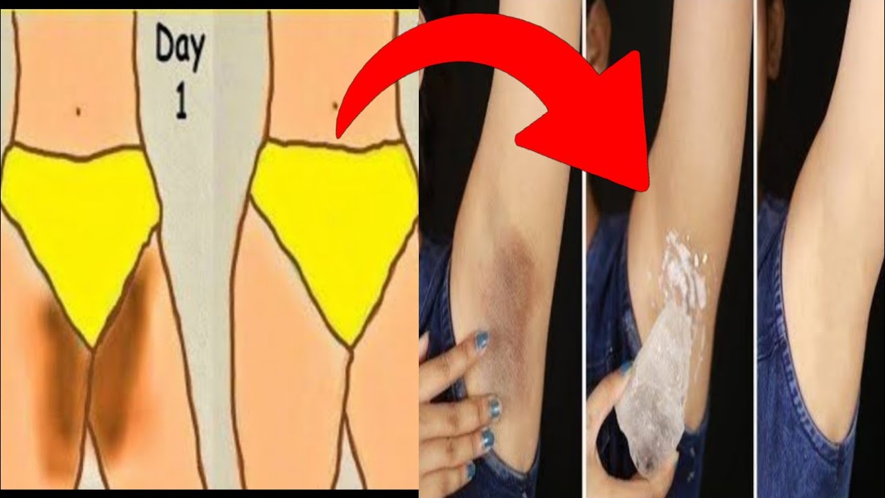 Lighten Your DARK VAGINAL AREA Naturally At Home Within 3 DAYS