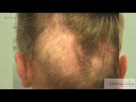 Worst Hair Transplant Result - Repair Using FUE & BHT, with Beard & Body Hair - Dr Umar part 2 of 3