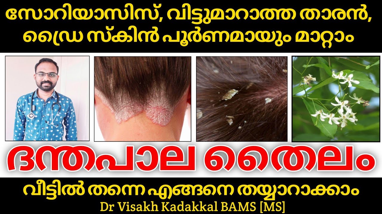 സോറിയാസിസ്, താരൻ, ഡ്രൈ സ്കിൻ : ദന്തപാല തൈലം | Dantapala Oil for Psoriasis, Dandruff, Dry Skin |