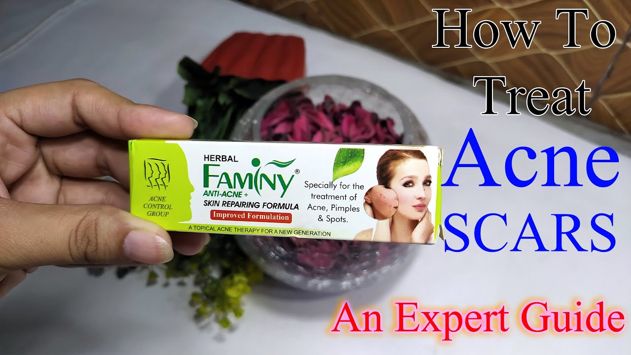 Faminy Anti Acne Cream | Treatments for ACNE SCARS | Best Treatment For  Acne | Remove Acne naturally - YouTube