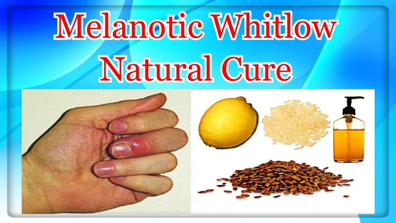 melanotic whitlow Melanotic Whitlow Natural Cure