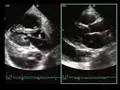 Pericardial Effusion versus Pleural Effusion