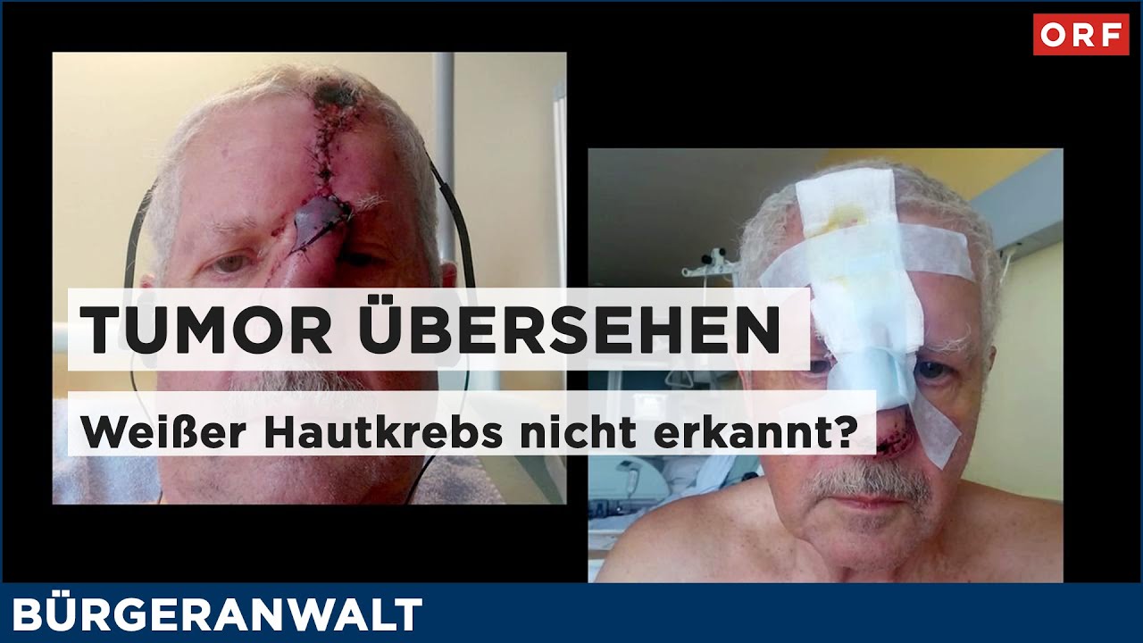 Weißer Hautkrebs nicht erkannt? | Bürgeranwalt 14.06.2025