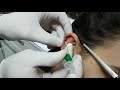 Kıkırdak  Helix Piercing Delimi Ankara