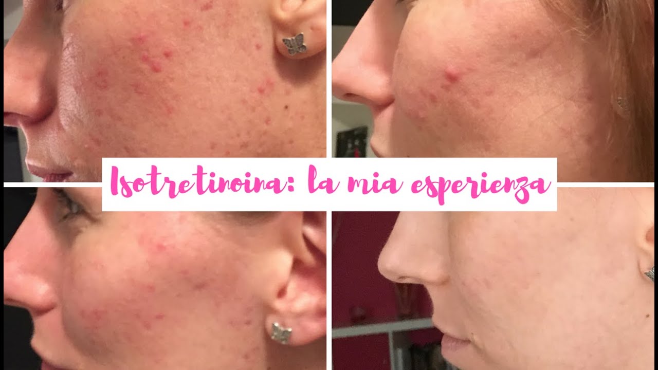Peeling della pelle di acne