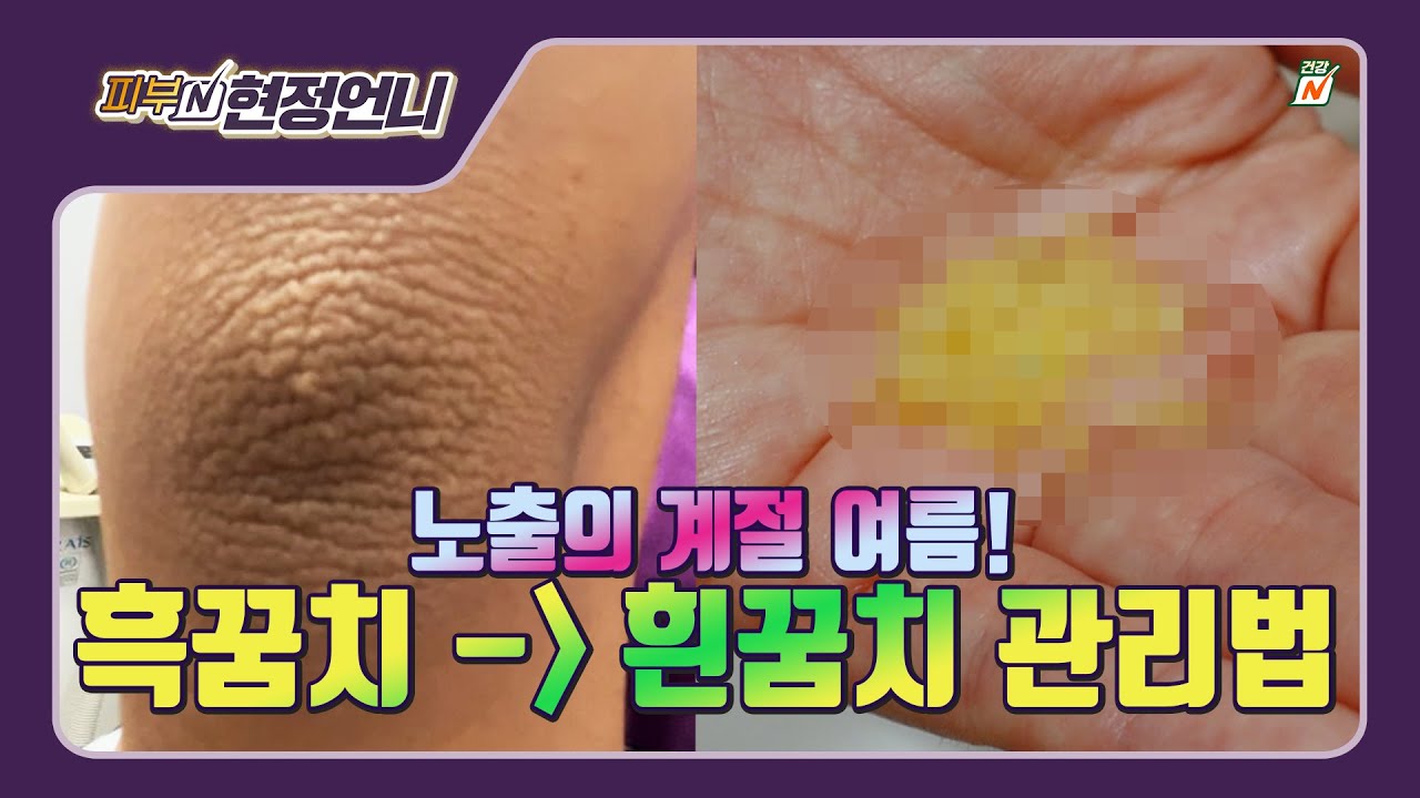까만 팔꿈치 무릎 하얘지는 법 ㅣ자가관리법 + 미백 크림 성분 추천 - YouTube