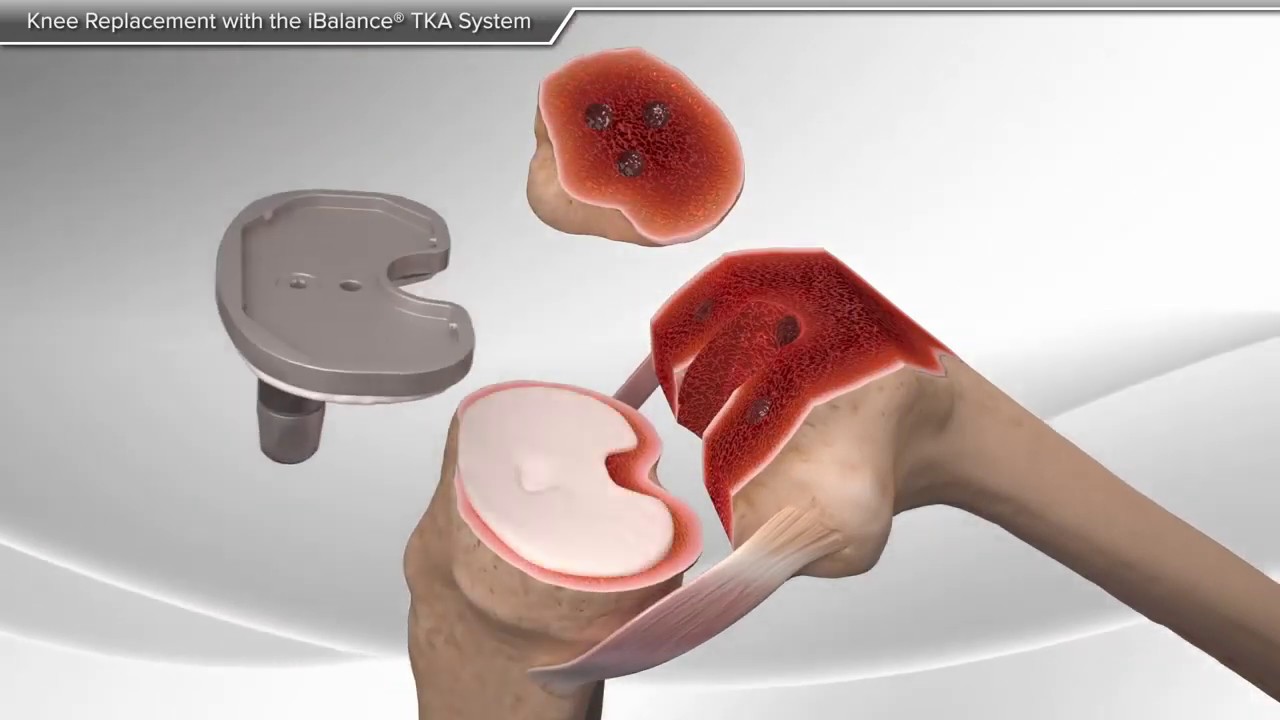 Prothèse Totale du Genou Dr Sailhan Dr Kerboull Dr Postel