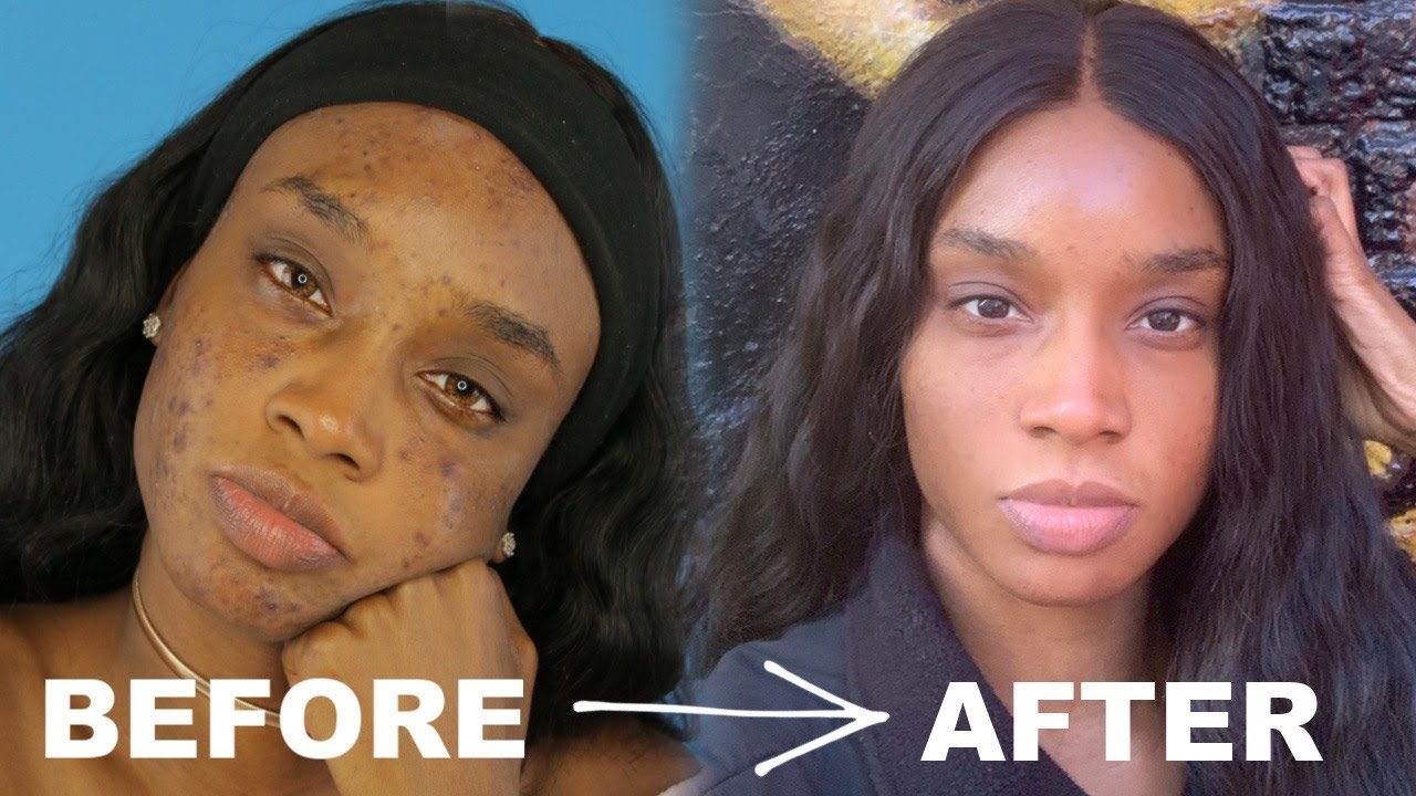 skin care routine to remove dark spots