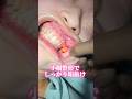 【小顔整形】小顔整形でしっかり垢抜け#shorts