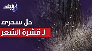 حل سحري لعلاج قشرة الشعر