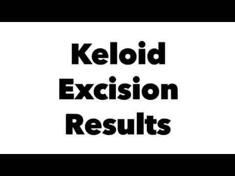 Dallas Keloid Removal Before and After