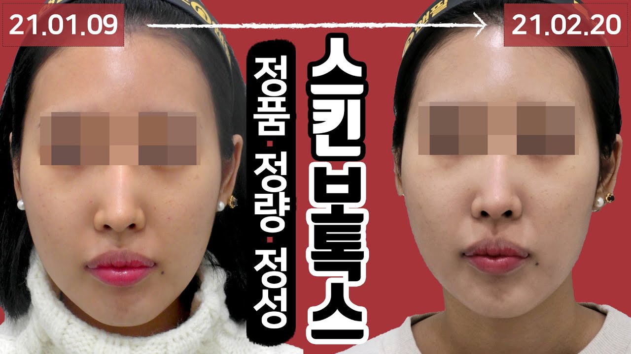 문정역피부과에서 스킨보톡스 3