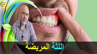 اضطرابات الفم و الأسنان ….. التهاب اللثة  - الدكتور كريم العابد العلوي -