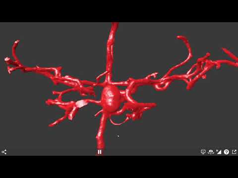 Aneurysm at the tip of the basilar artery